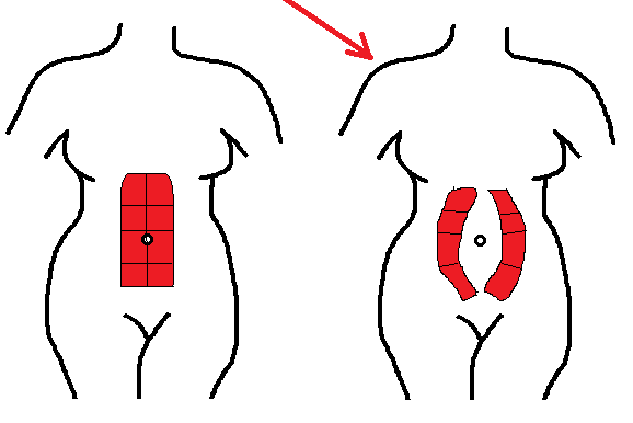 illustration of abdominal separation due to diastasis recti