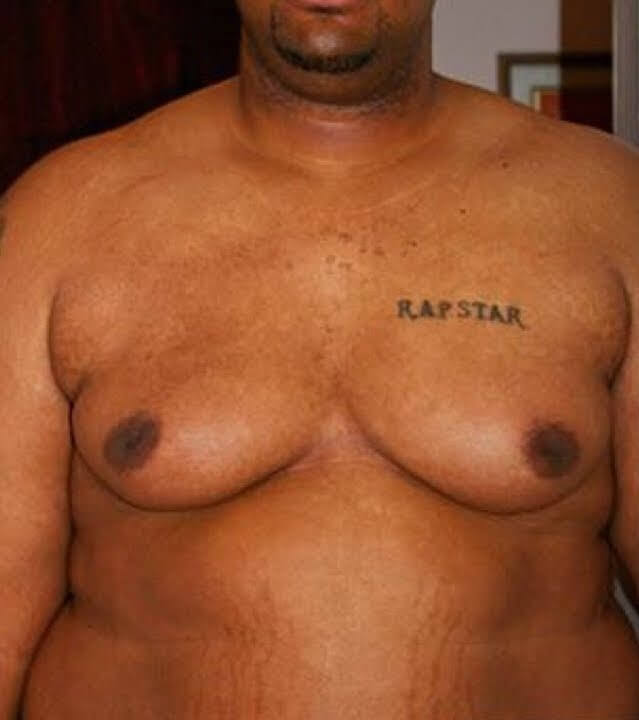 You might be wondering is it okay for a man to wear a bra? Here is a man with enlarged breasts, a condition called gynecomastia, or man boobs in slang language. This condition necessitates such a man to wear a bra when participating in sports or when he wants to wear tight clothing