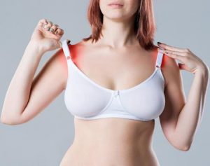 A lady with a reddish bra rash on her shoulders due to a bra whose straps are too tight. This is one of the common bra problems